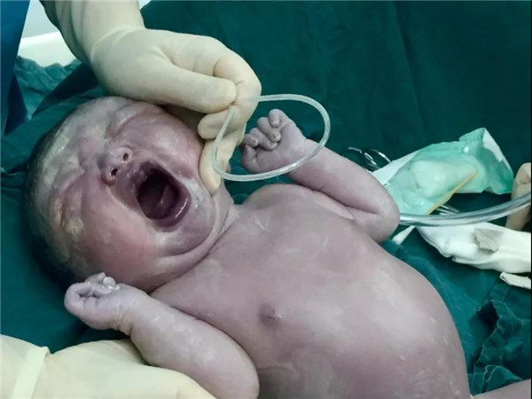 Center medics rescue fetus with pleural effusion